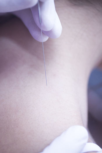 Cropped hand of acupuncturist applying acupuncture needle to woman neck