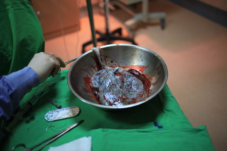 Bowl with internal organ of human in operation room