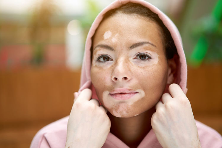 Close-up portrait of a young woman with vitiligo