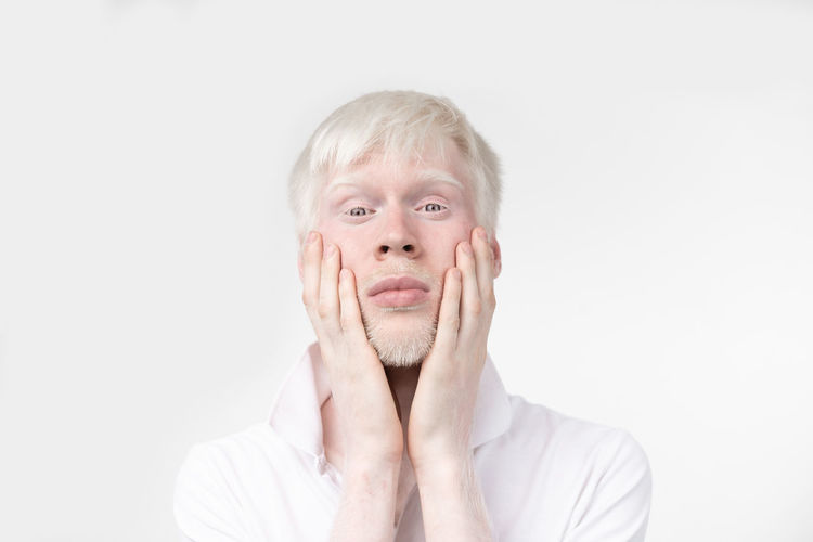 Portrait of young man with albino against white background
