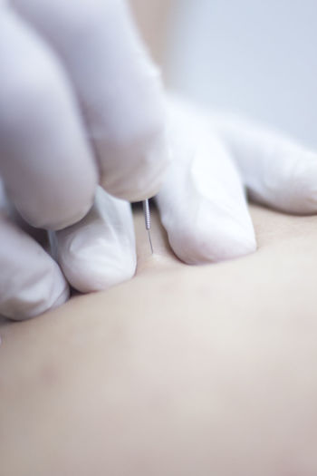 Cropped hands injecting acupuncture needle on patient skin