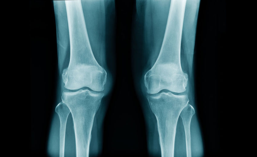 Medical x-ray image of knees and legs