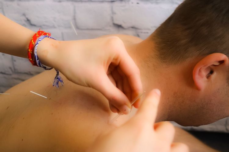 Cropped hand of female acupuncturist applying needle on man back