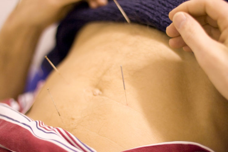 Midsection of person receiving acupuncture treatment