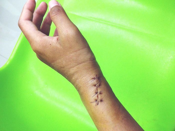 Cropped image of injured hand with stitches