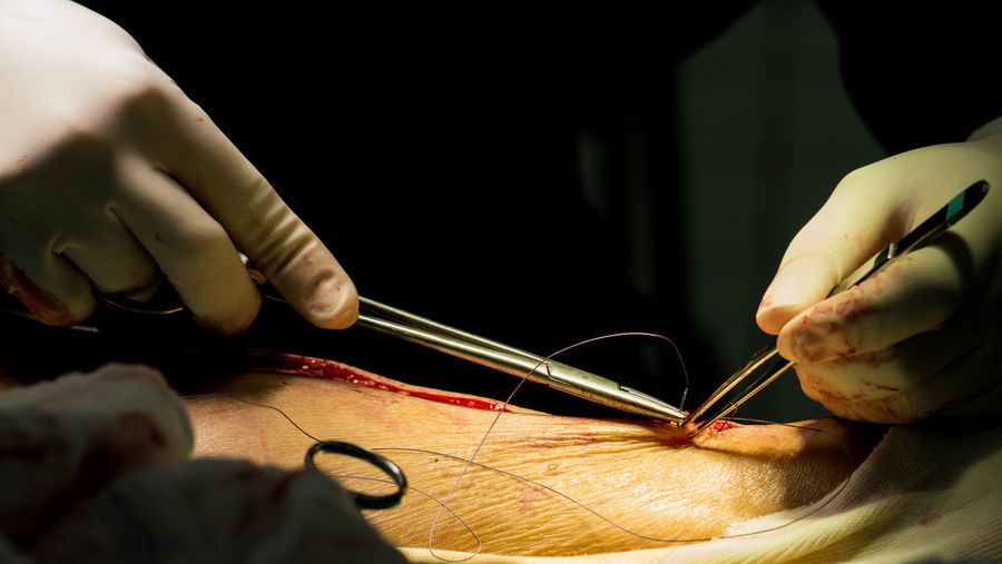 Cropped hands of doctor stitching human skin