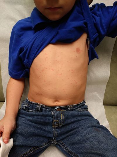 Midsection of boy with skin disease