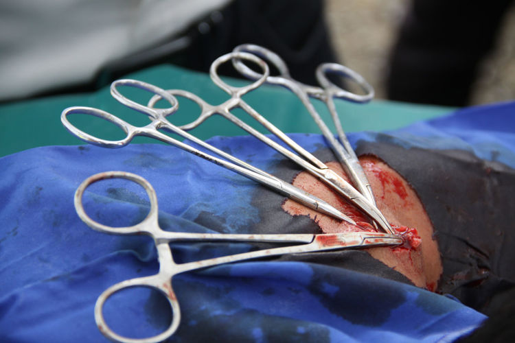 Close-up of scissors on patient body at hospital