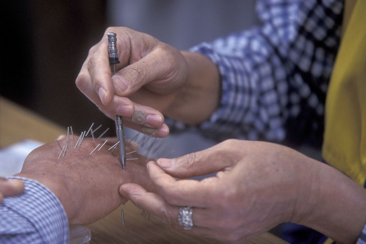 Cropped image of person getting acupuncture treatment