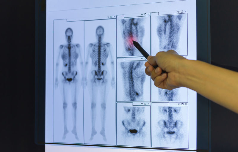 Doctor hand pointing on skeleton x-ray film