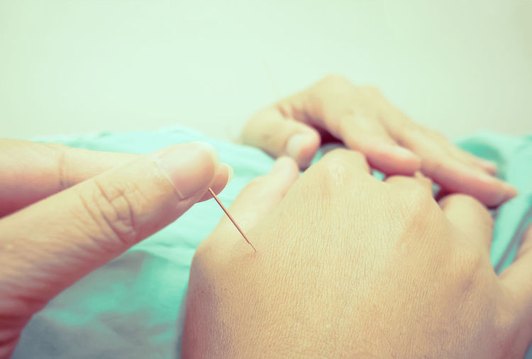 Cropped image of doctor injecting acupuncture needle on patient hand
