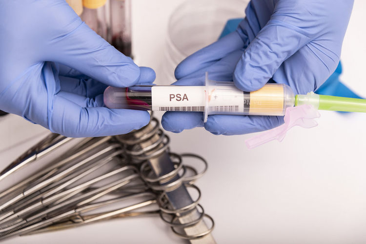 Blood sample with abnormal high psa test result.