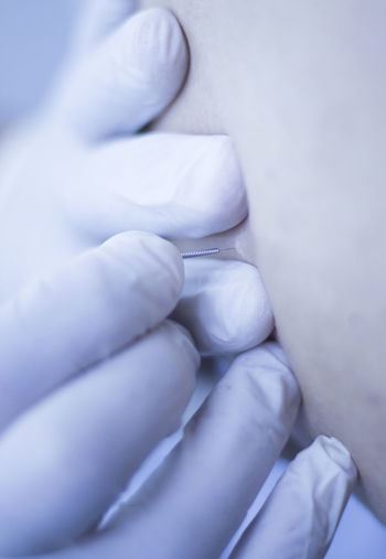 Close-up of person undergoing acupuncture treatment
