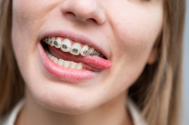 Close-up of woman with braces on teeth